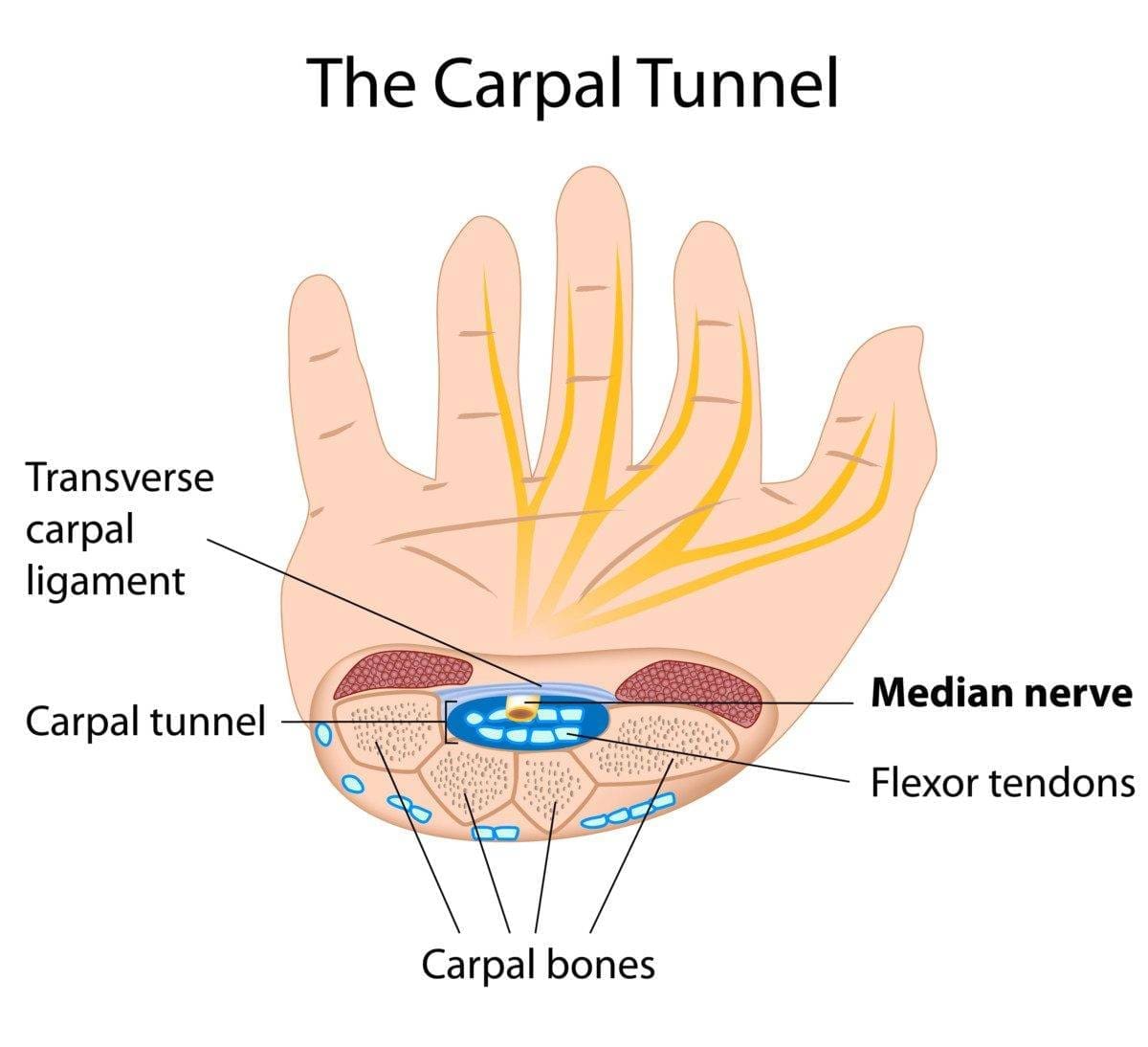 Carpal tunnel syndrome, eps8